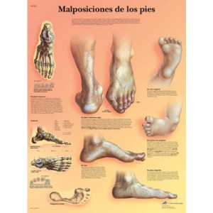 Lámina 3B Malposiciones de los pies